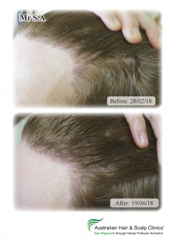 Hair Loss & Alopecia Areata Treatment Melbourne | Natural Hair Regrowth