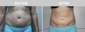 Get A Great Body With Chelsea Cosmetics' Liposuction Surgery in Melbourne - Contact Us Today!