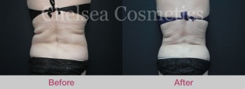 Get A Great Body With Chelsea Cosmetics' Liposuction Surgery in Melbourne - Contact Us Today!