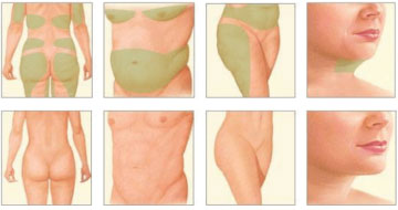 Get A Great Body With Chelsea Cosmetics' Liposuction Surgery in Melbourne - Contact Us Today!