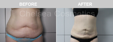 Get A Great Body With Chelsea Cosmetics' Liposuction Surgery in Melbourne - Contact Us Today!