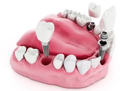 Nepean Dental Implants in Penrith