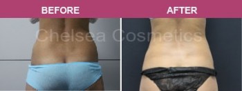 Chelsea Cosmetics' Coolsculpting Procedure in Melbourne - $850 Per Cycle!