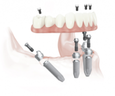 All On 4 Dental Implants Cost In Austral