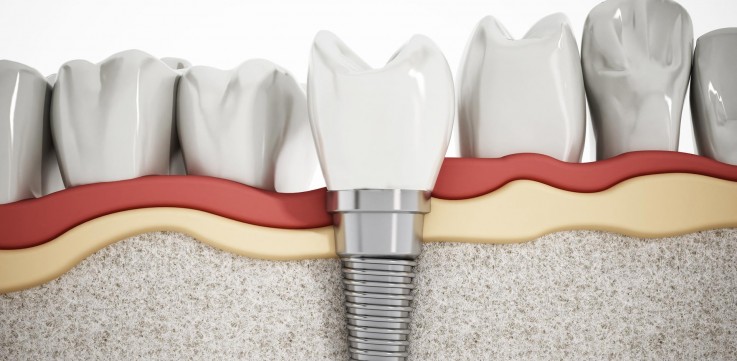 Get Best teeth implants in Melbourne | Prahran Family Dental