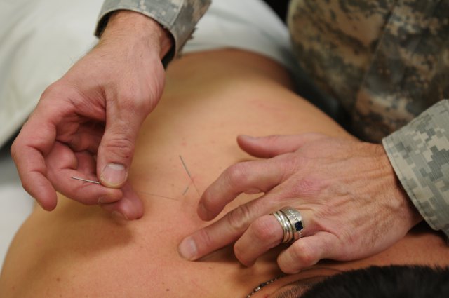 Acupuncture, Chinese herbal medicine and Cupping