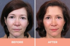  Lower Eyelid Blepharoplasty in Sydney by Dr. Hodgkinson - Visit Us Now!