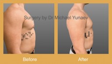  Professional Male Breast Reduction Surgery in Sydney - Contact Us Now!