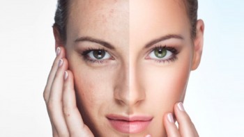 Skin Rejuvenation Sydney | Get Rid Of Gummy Smiles 