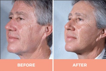 High-Quality Lower Face Lift Surgery in Sydney -  Contact Dr Hodgkinson Today!