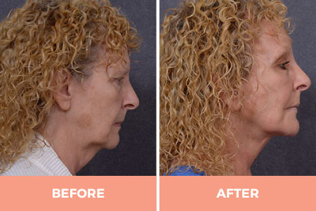 High-Quality Lower Face Lift Surgery in Sydney -  Contact Dr Hodgkinson Today!