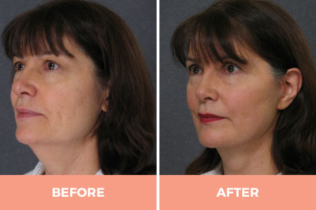 High-Quality Lower Face Lift Surgery in Sydney -  Contact Dr Hodgkinson Today!