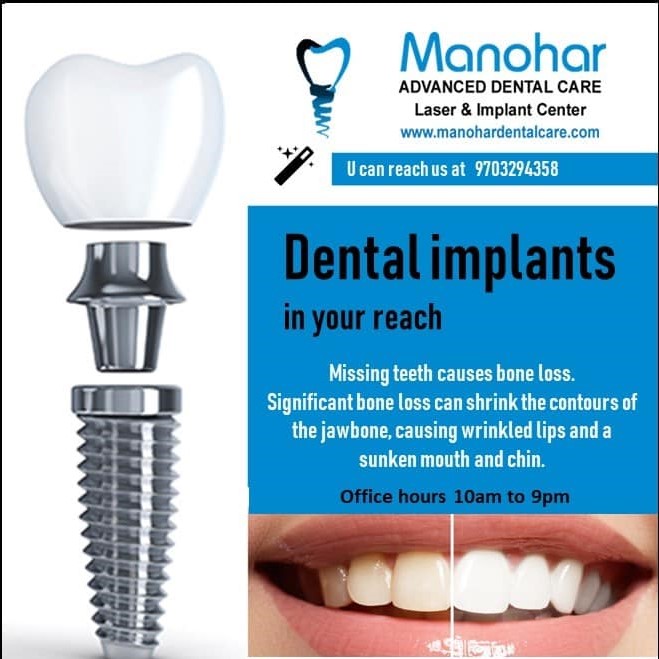 fluoride treatment in vizag |Manohar dental care 