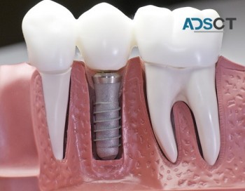 Replace Your Missing Teeth With Dental Implants