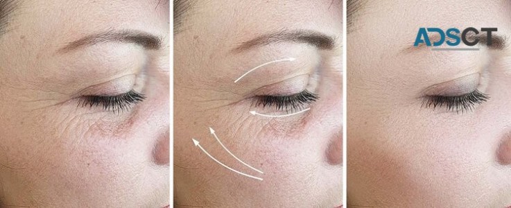 Anti Wrinkle Treatment Brisbane