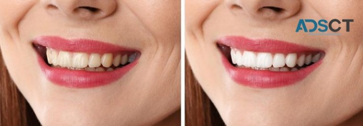 Get a Dazzling Smile By Teeth Whitening in Brunswick