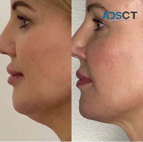 Best Dermal Fillers Brisbane