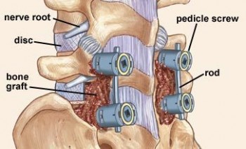 Reputed Spinal Fusion Surgery Clinic in Melbourne