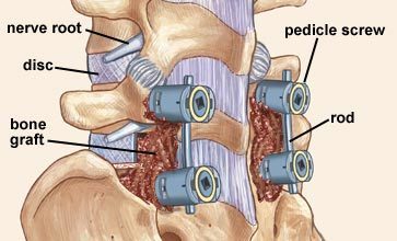 Reputed Spinal Fusion Surgery Clinic in Melbourne