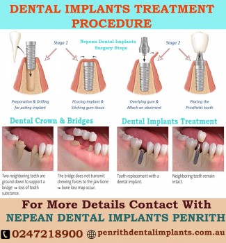 Affordable All-on-4 Dental tooth Implants at best prices in Penrith