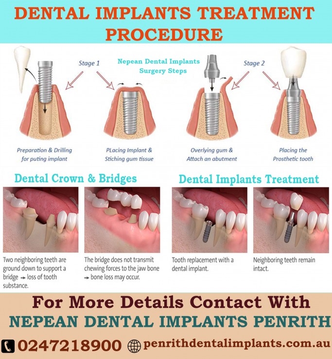 Affordable All-on-4 Dental tooth Implants at best prices in Penrith