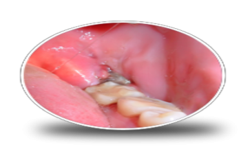 Emergency Dentist Melbourne - Wisdom Teeth Dentist