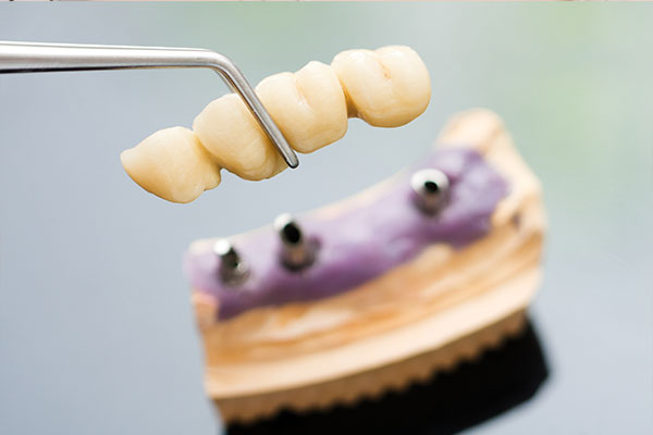 Professional Dental Bridge Melbourne