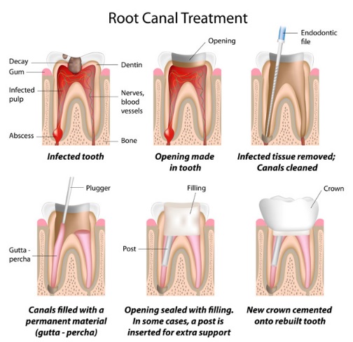 Root Canal Therapy Melbourne | Prahran Family Dental