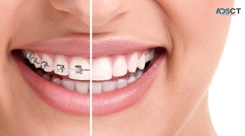 Achieve Your Best Smile with Clear Braces Orthodontist in Sydney